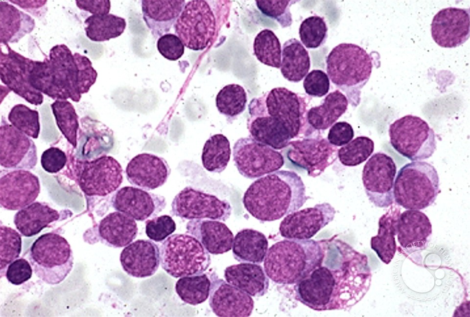 acute_lymphoblastic_leukemia