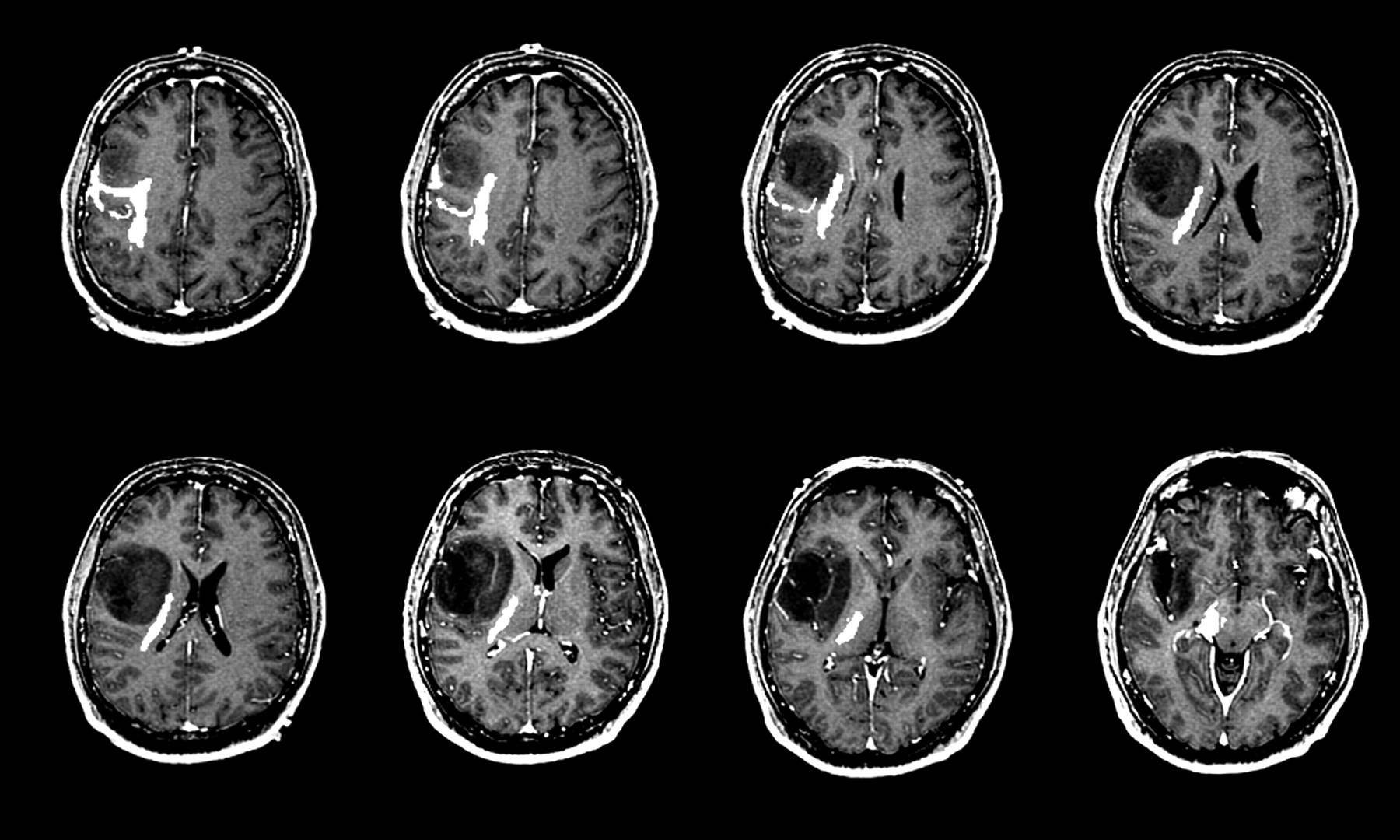 What Does A Mass Look Like On An Mri