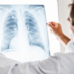 What to Expect During Stage 2 Lung Cancer Treatment: A Beginner’s Guide