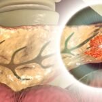 Why Pancreatic Cancer Is So Hard to Detect (and What’s Changing)