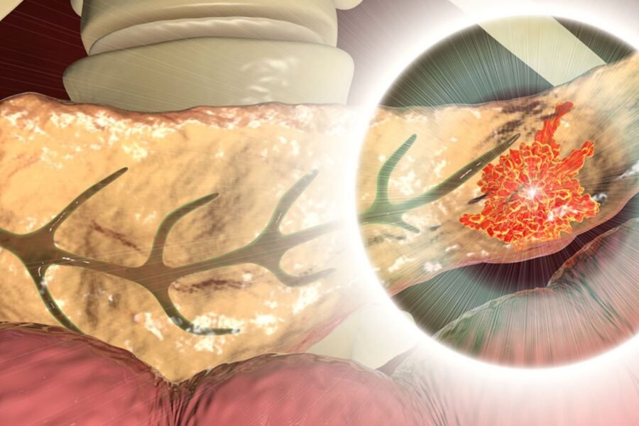 Why Pancreatic Cancer Is So Hard to Detect (and What’s Changing)